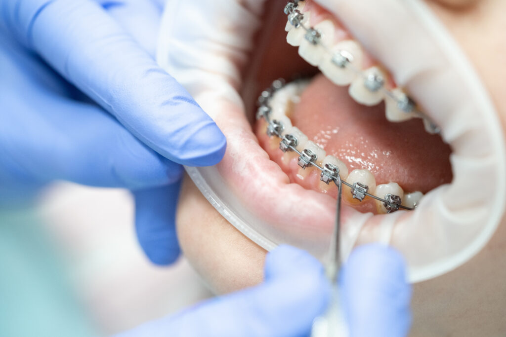 braces procedure