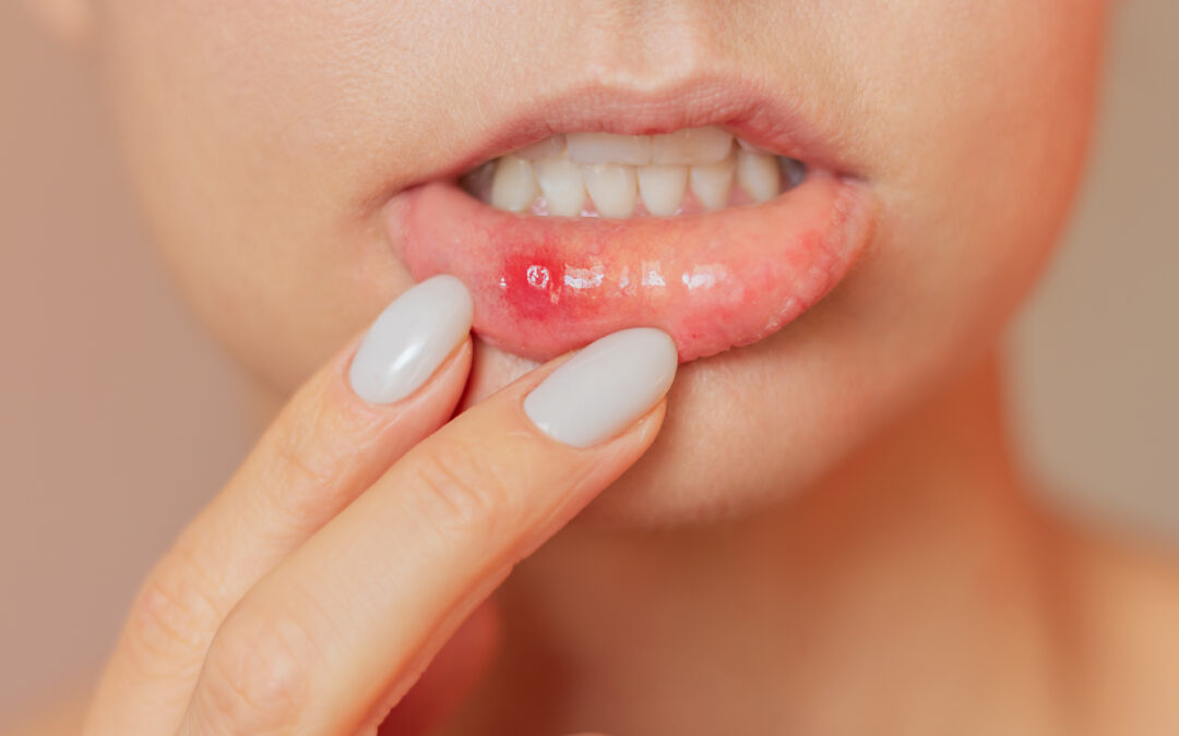 mouth ulcer