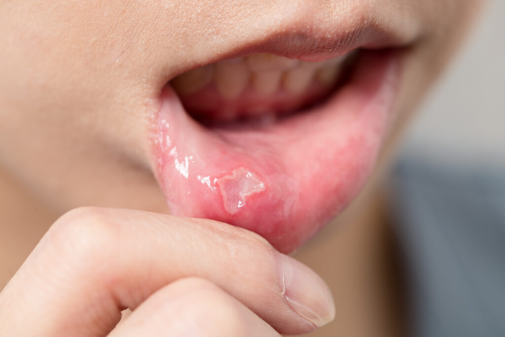 mouth ulcer in a girl's mouth