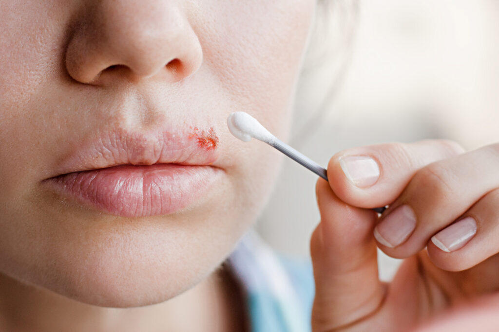 woman with cold sore 